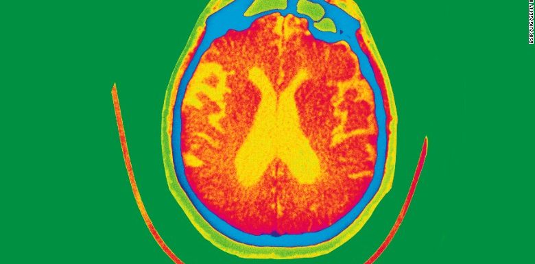 Blood test could detect Alzheimer’s up to 16 years before symptoms begin, study says