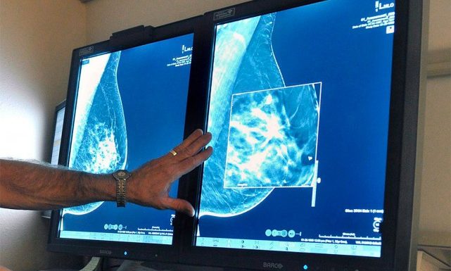 Un test de salive pour prédire les risques de cancer du sein
