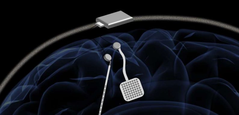 Un « pacemaker cérébral » pour traiter les maladies neurologiques