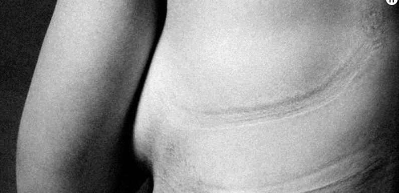 Il photographie les marques laissées par les vêtements pour dénoncer les diktats