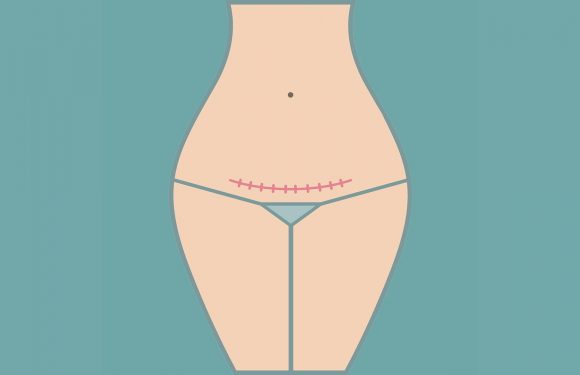 « J&rsquo;ai faisais hémorragie sur hémorragie » : trois femmes racontent leur endométriose