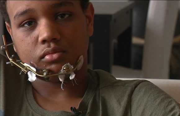 TÉMOIGNAGE – Lilian, blessé au visage en marge d&rsquo;une manif: “qu&rsquo;on arrête de dire que je suis un casseur”