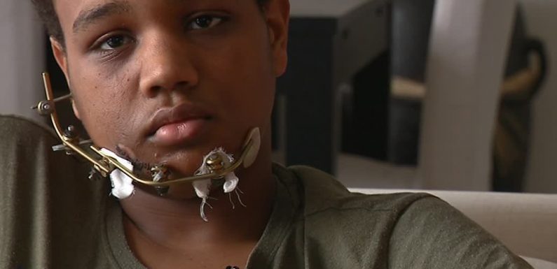 TÉMOIGNAGE – Lilian, blessé au visage en marge d’une manif: “qu’on arrête de dire que je suis un casseur”
