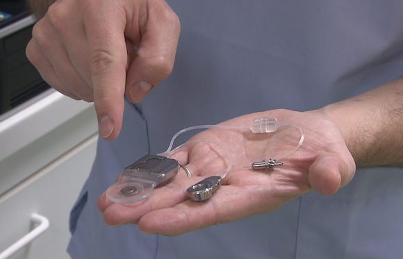 Un nouvel implant auditif invisible