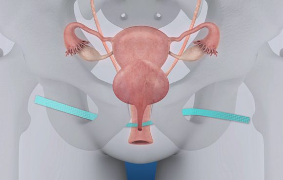 Implants défectueux : « Ça fait tellement mal que je ne peux pas m’asseoir »