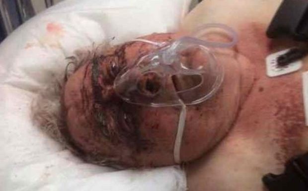 Suède : Ivar, 83 ans, a été atrocement torturé chez lui par des agresseurs qui voulaient son argent, il est grièvement brûlé et ses oreilles ont été arrachées