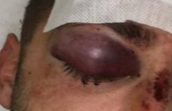 Italie : un migrant marocain agresse un policier de Viareggio à coups de brique