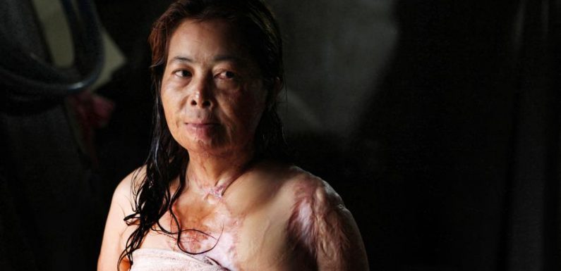 Cambodge : Les victimes d’attaques à l’acide privées de soins et de justice