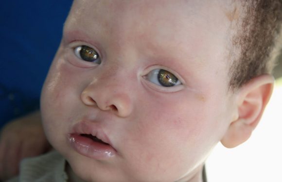 Afrique : plus de 700 attaques contre des albinos au cours des 10 dernières années (experte de l’ONU)
