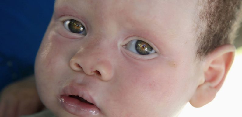 Afrique : plus de 700 attaques contre des albinos au cours des 10 dernières années (experte de l’ONU)
