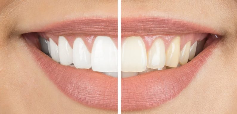 Blanchiment des dents : les produits en vente libre éroderaient les dents jusqu’au nerf