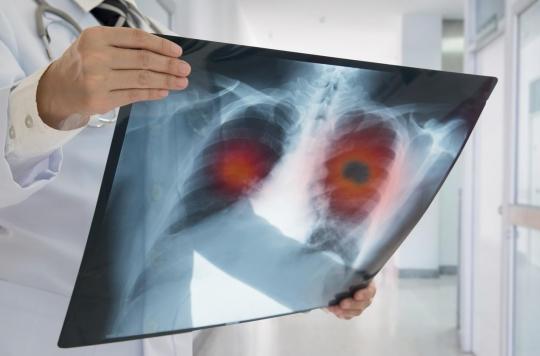 France : 40% des cancers pourraient être évités par une « modification des comportements »