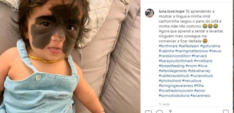 Une petite fille naît avec «le masque de Batman», les internautes se mobilisent pour lui financer une opération