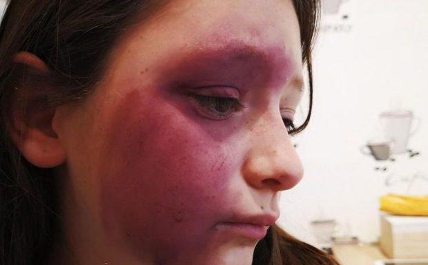 Couloisy (60) : Tallia, 10 ans, tabassée par 3 adolescents de 15 ans, vit dans la terreur et ne veut plus sortir de chez elle