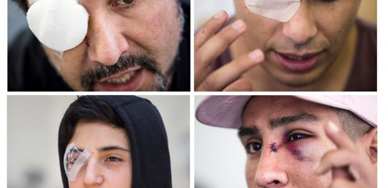 Pérdidas oculares en la represión de manifestantes conmueve en Chile