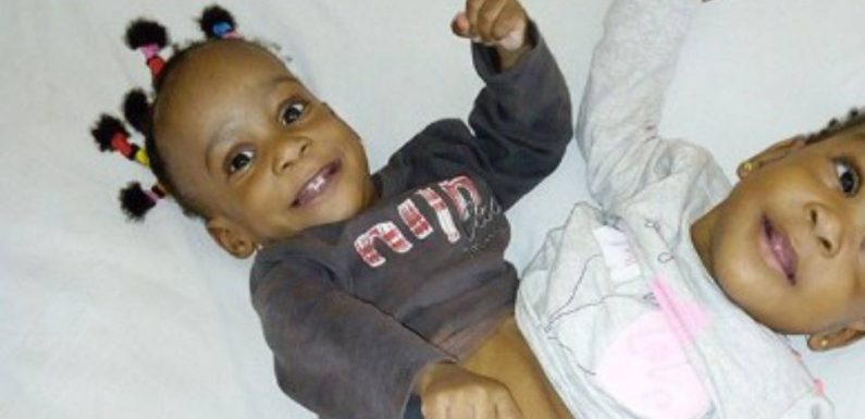 Lyon : L’opération des petites sœurs siamoises reportée