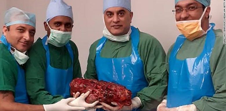 Doctors remove giant kidney weighing 16.3 pounds