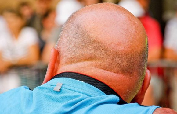Médicament anti-calvitie : Les patients mieux informés sur les effets indésirables