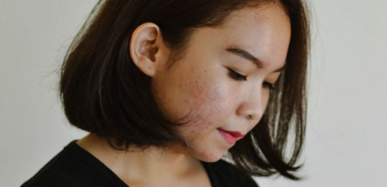 L&rsquo;acné hormonale, une guerre des boutons sans fin