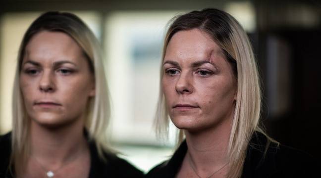 Oui, Rémi Gaillard a bien diffusé le véritable scanner d’une « gilet jaune » éborgnée