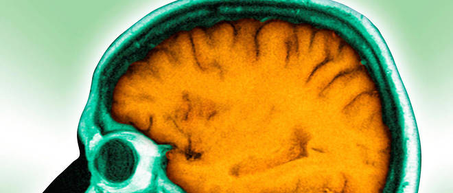 Après la mort, des cellules du cerveau restent fonctionnelles pendant 48 heures